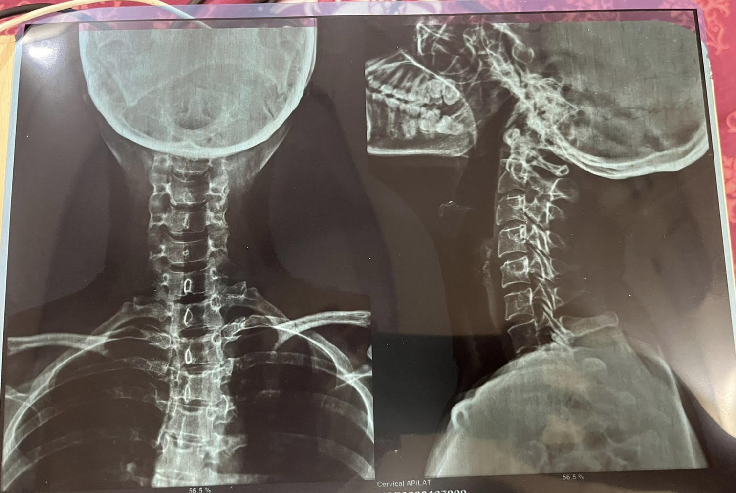 Step 01: Digital Spine X-Ray & MRI Biomechanical Diagnosis